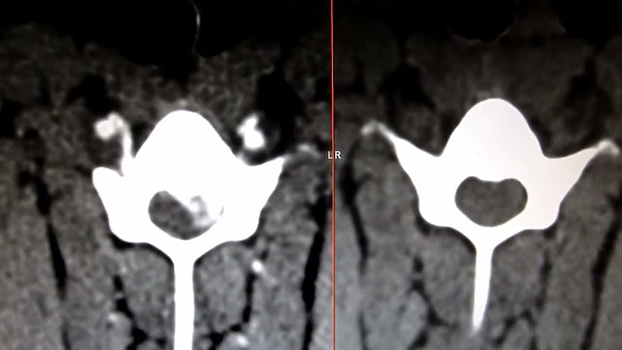 Tierklinik Schwanenstadt CT Bandscheibenvorfall beim Hund, pre und