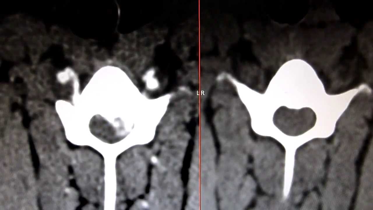 Tierklinik Schwanenstadt CT Bandscheibenvorfall beim Hund, pre und