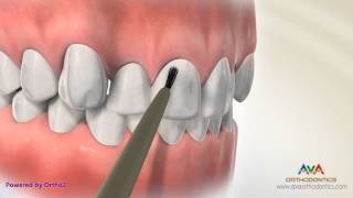 Putting Orthodontic Braces On or Bonding - Indirect vs. Direct Technique