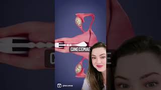 Como Funciona A Histerossalpingografia?