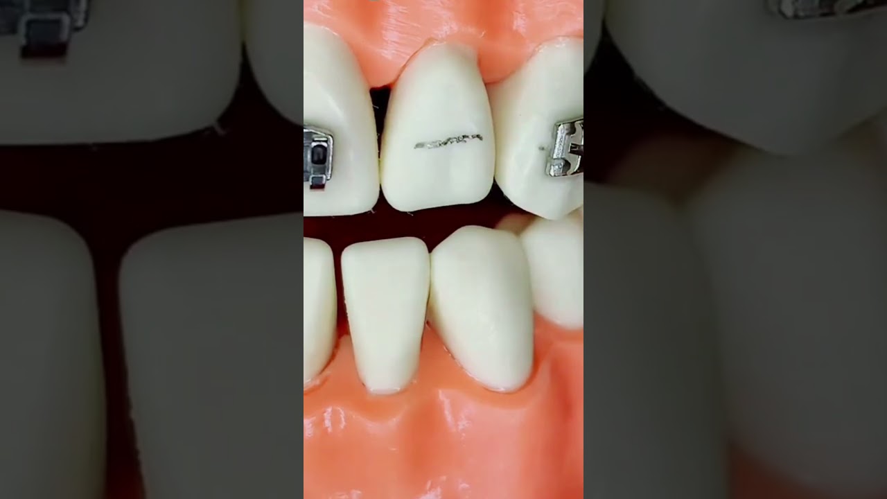 #teeth