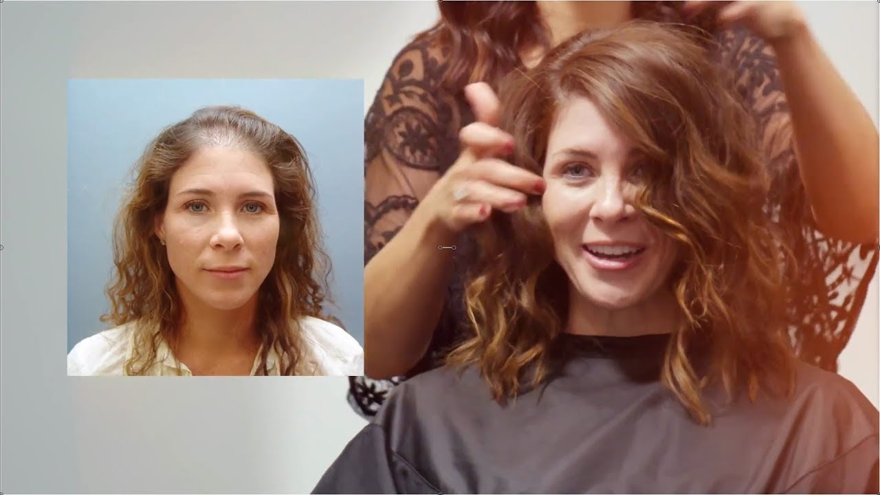 Atlanta Hair Transplants with NeoGraft