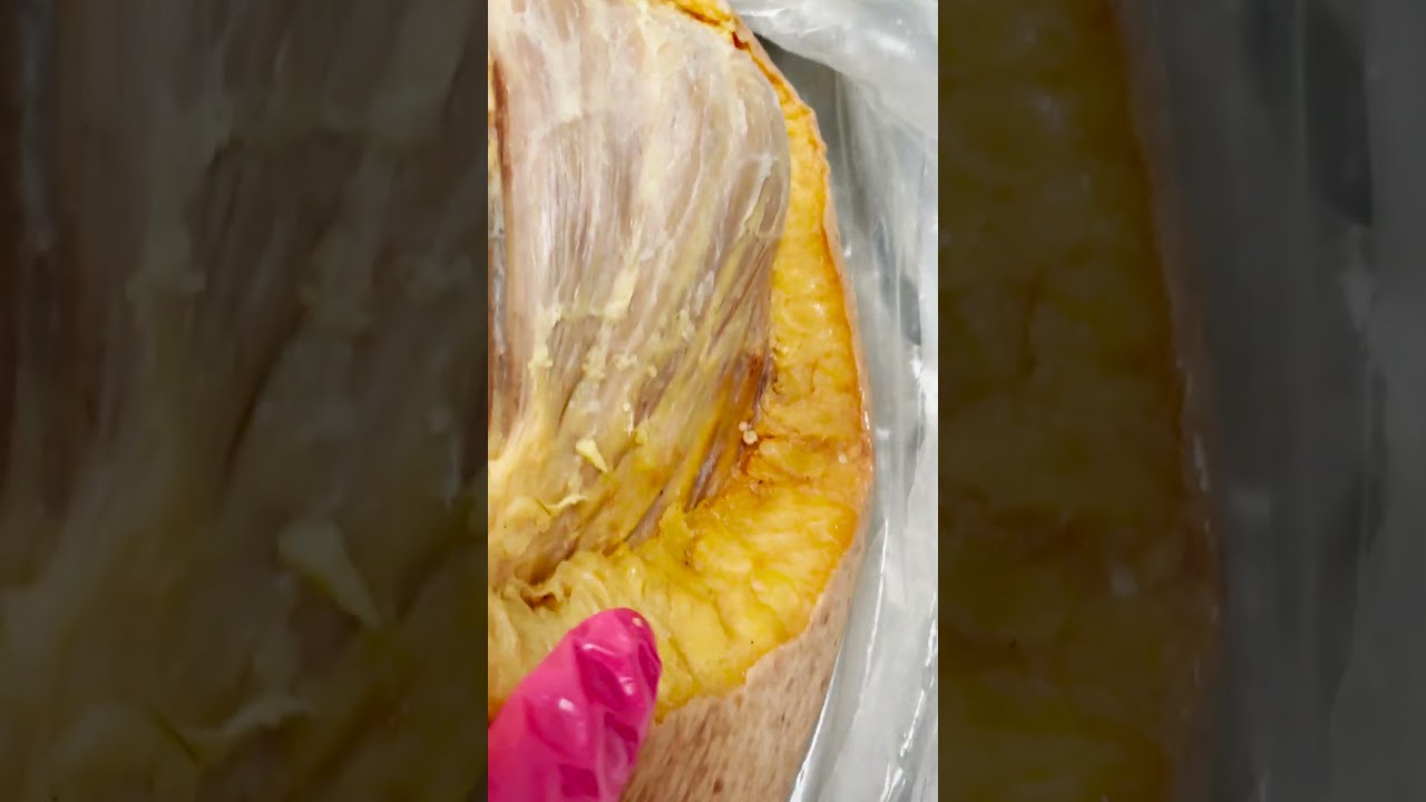 Subcutaneous Layer of Adipose Tissue