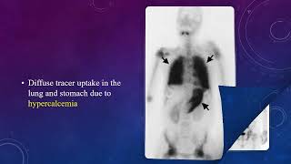 Extraosseous Uptake on Bone Scan MCQS #nuclear_medicine_MCQ #nuclear_medicine  #RSO #frcr #bone_scan
