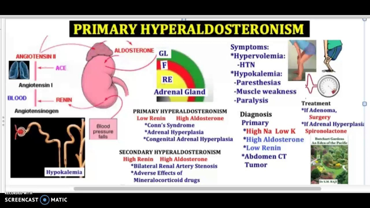PRIMARY HYPERALDOSTERONISM in 3 minutes YouTube