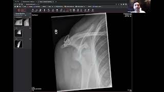 Don’t Miss the Y View! A Practical Guide to Shoulder Dislocation on X-Ray