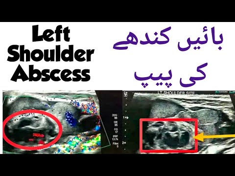 Ultrasound video showing Soft Tissue Abscess | Infected Collection