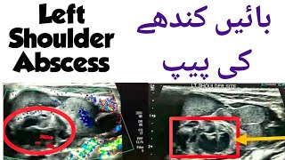 Ultrasound video showing Soft Tissue Abscess | Infected Collection screenshot 4