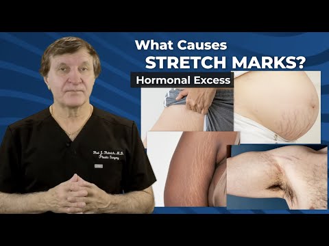 Stretch Marks: Plastic Surgery Hot Topics with Rod J. Rohrich, MD