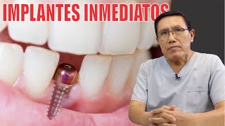 IMPLANTE DENTAL INMEDIATO  En una SESIÓN  reemplazo dental en 1  Dr YURI MARTINEZ  Prodent Perú