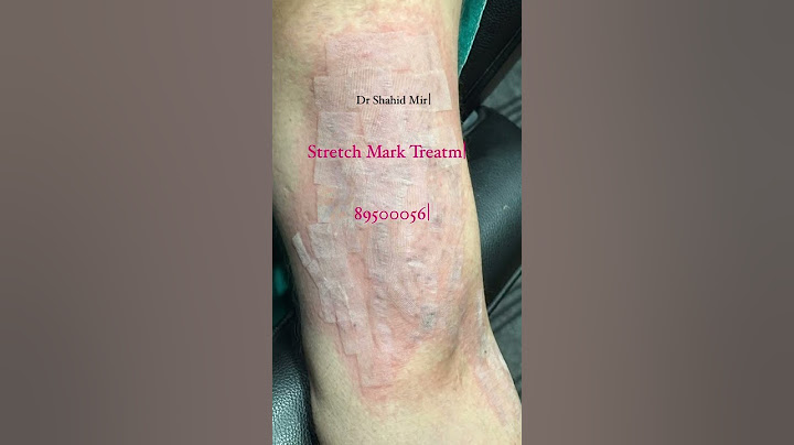 Co2 Laser for Getting  Stretch Mark Treatment | Co2 Laser Treatment |Scar Treatment #viral #shorts