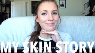 MY SKIN STORY | HOW I CLEARED MY CYSTIC ACNE + HYPERPIGMENTATION