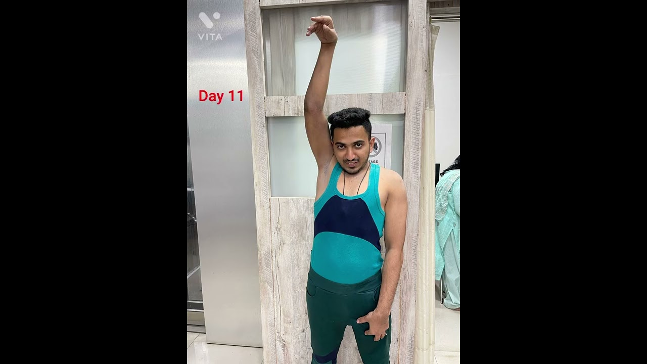 Fracture shaft of humerus with radial nerve palsy