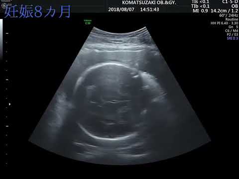 妊娠8カ月29w4d TANTANエコー動画初4D탄탄이 초음파동영상4D