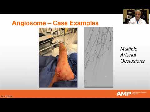 AMP 2020 Virtual | Angiosome Directed Access