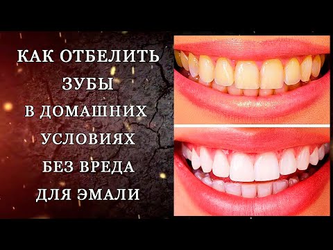 Отбеливание зубов в домашних условиях без вреда для эмали и зубов