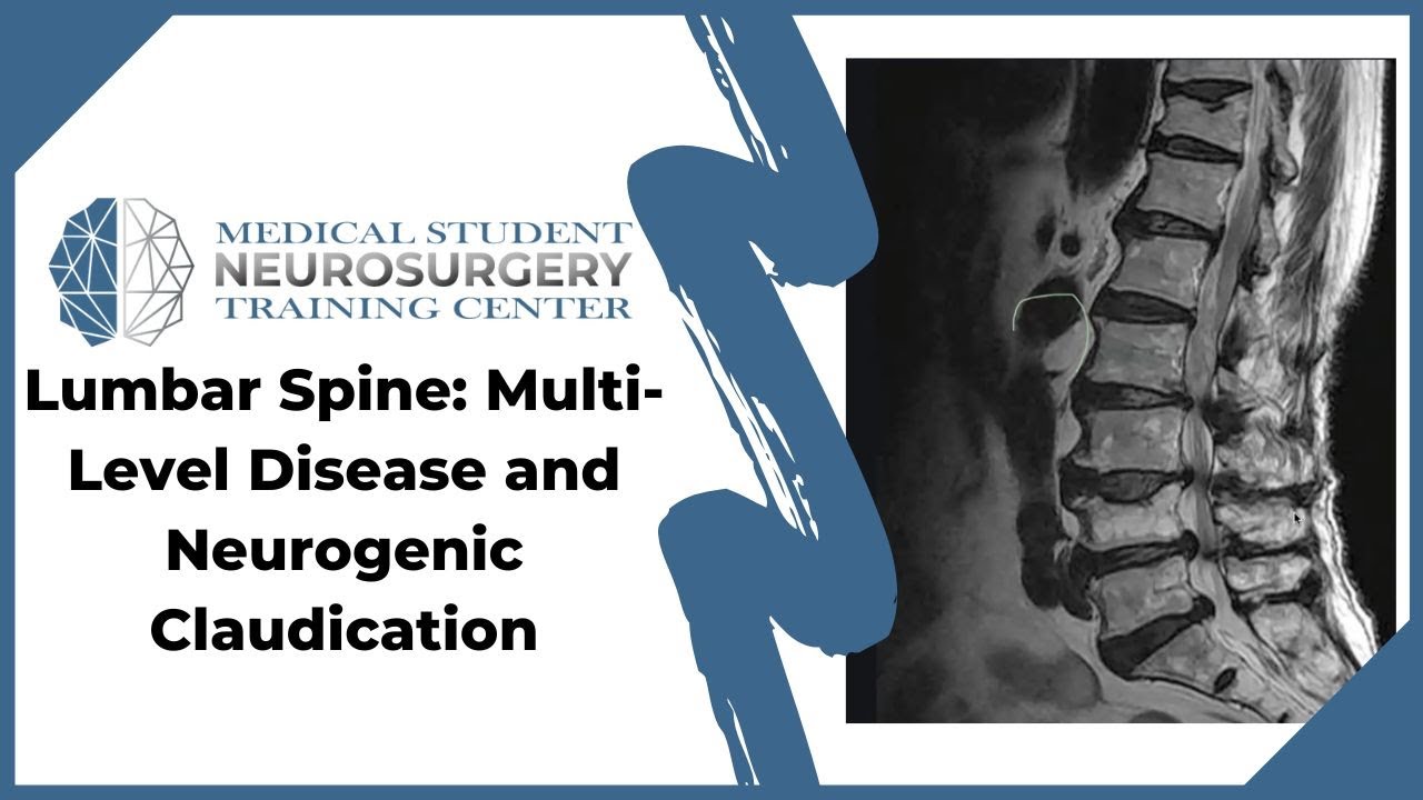 Spinal Stenosis - Neurosurgery