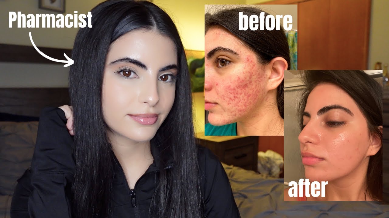 How I Cleared My Severe Cystic Acne: Simple Skincare Routine & The BEST ...
