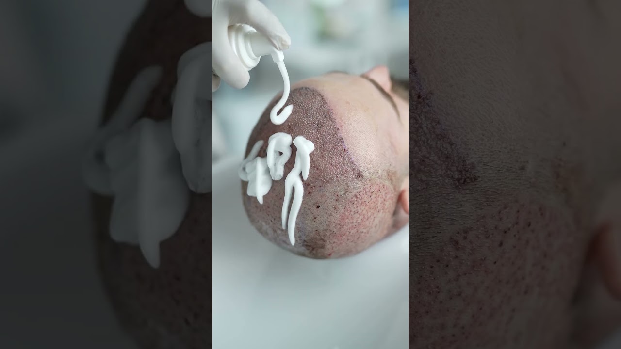 A hair transplant requires proper post-surgery care, including a washing process using shampoo foam