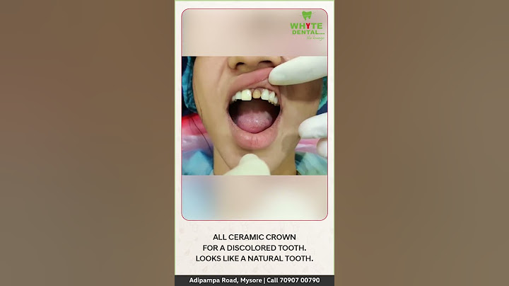 All ceramic crown/ Dental cap for a discolored black tooth.