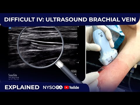 Video: Le vene brachiali sono accoppiate?