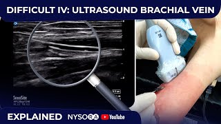 Difficult Iv Ultrasound Guided Brachial Vein