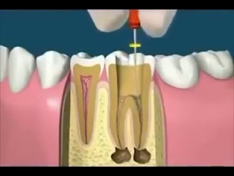 Cara menyembuhkan sakit gigi membunuh ulat gigi belatung gigi
