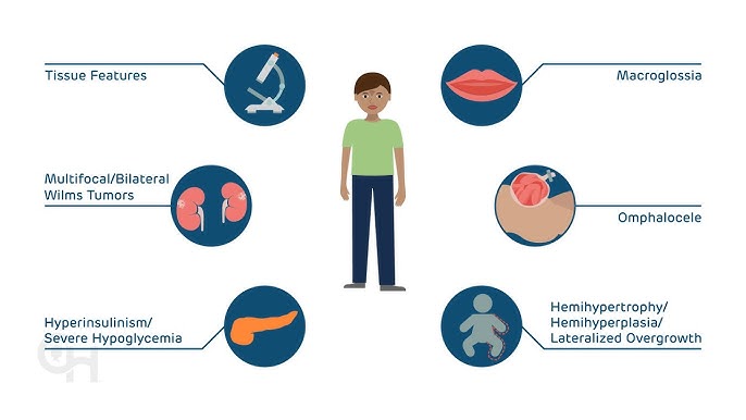 beckwith wiedemann syndrome adult