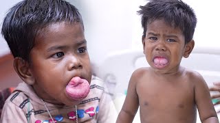 Large Tongue Tumor Removal for a 2 Year Old Boy