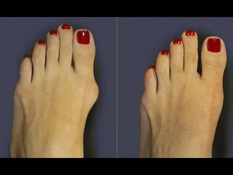 Видео: ★ Как избавиться от косточки на ноге. Операция по удалению шишки на ноге. Вальгусная деформация стоп