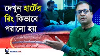 হার্টের রিং কিভাবে পরানো হয় সরাসরি ভিডিও | Heart Ring Live Surgery | Medical Post