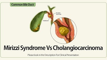Mirizzi Syndrome Vs Cholangiocarcinoma