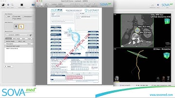 Best of EVAR planning software SOVA.evar 1.1