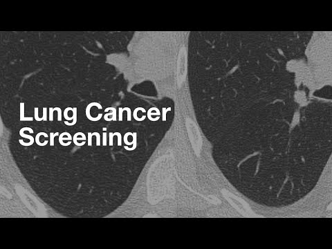 تصویری: نحوه غربالگری سرطان ریه: 12 مرحله (همراه با تصاویر)