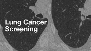 Lung Cancer Screening (basics for patients)