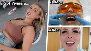 I Flew To Turkey To Get Veneers.. *i got vampire teeth lol*