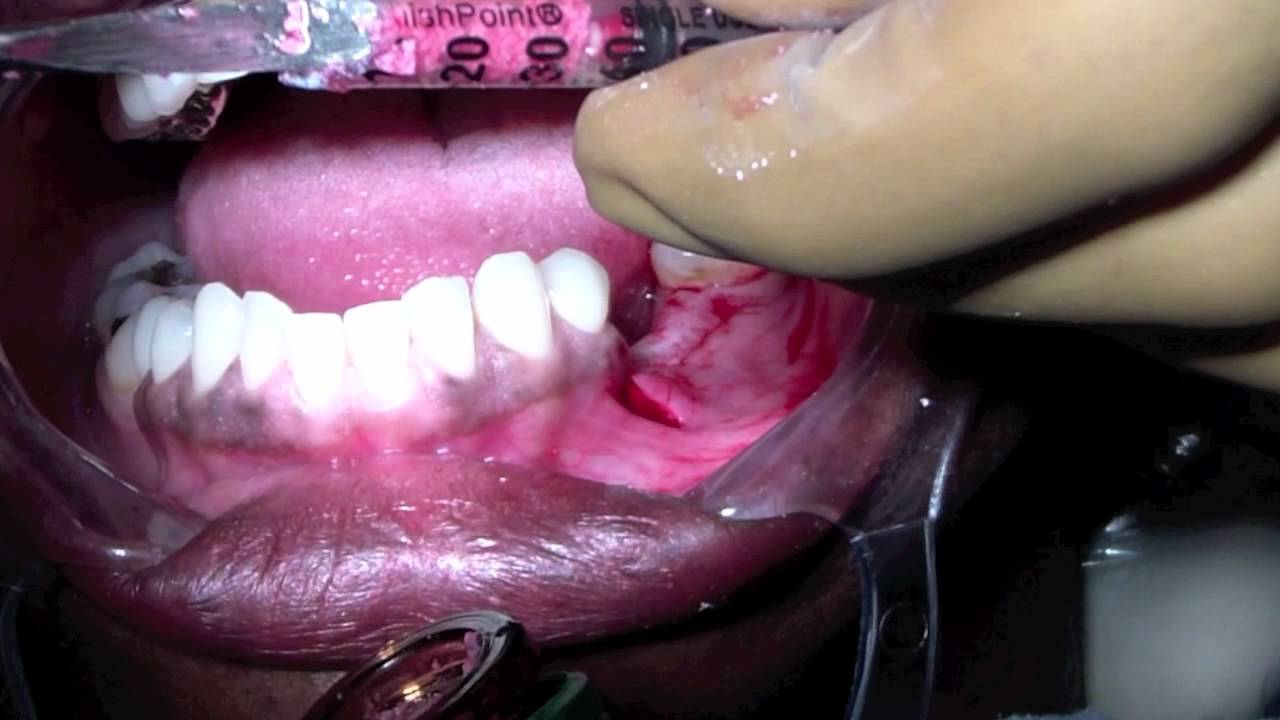 filling up Dental Bone Graft - Tunnelling