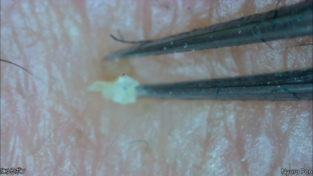 0187 keratin plug removal cheek YouTube