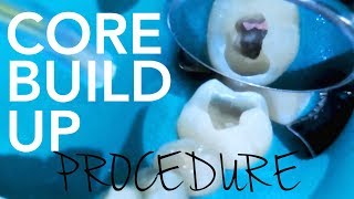 Root Canal Demonstration | Core Build Up Procedure