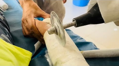 Cutting Off Cast | Removing plaster from fractured hand | Removing Cast From Hand | DD by HT