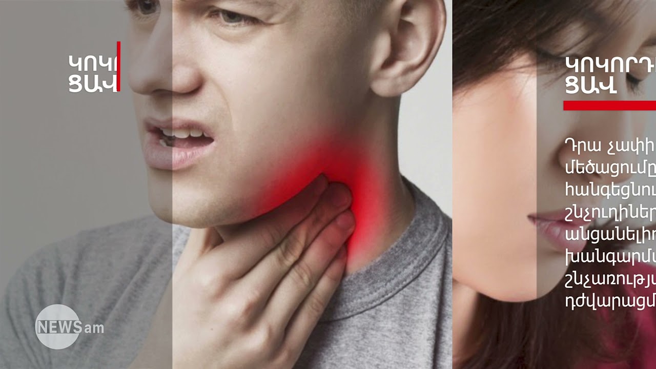 Կոկորդի ցավ. ե՞րբ է այն վտանգավոր