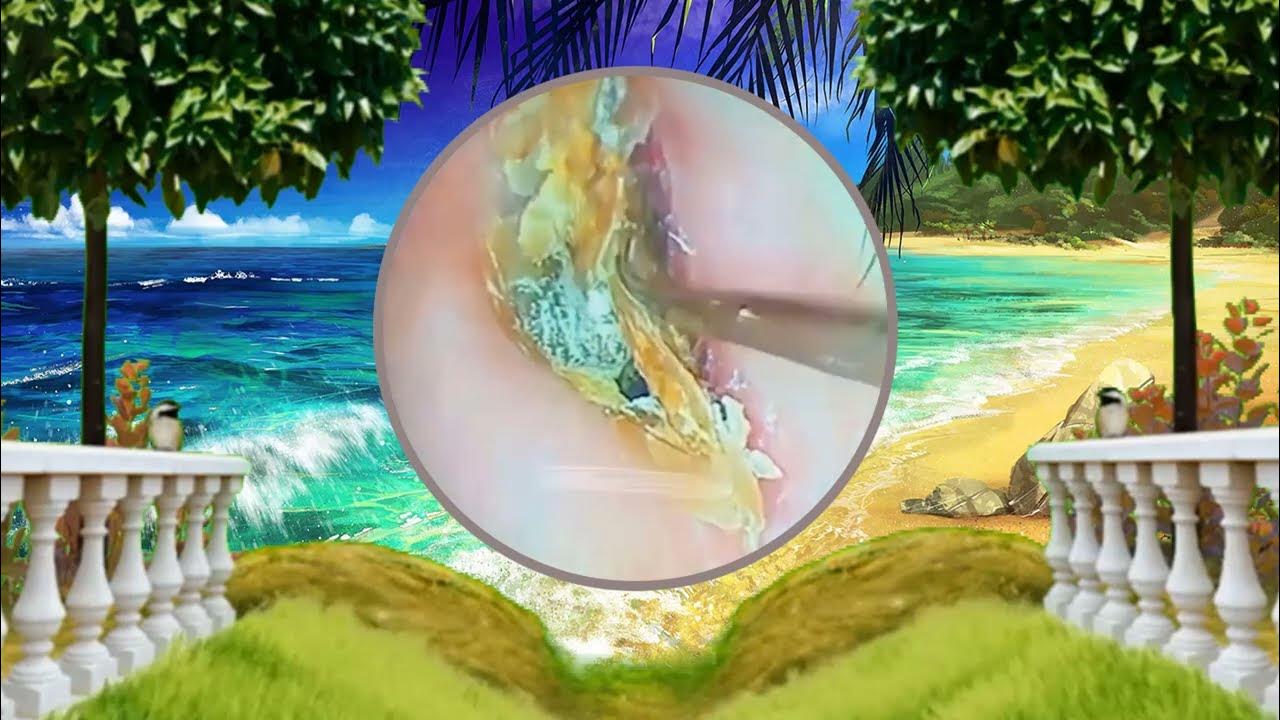 Satisfying Ear Wax Removal With Dr Zhao Video 252 YouTube