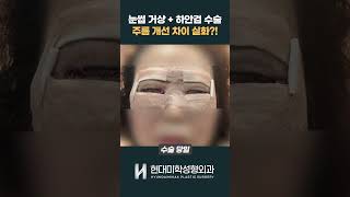 중년 눈썹하거상+하안검 수술 3개월 차 전후 비교 후기🔥