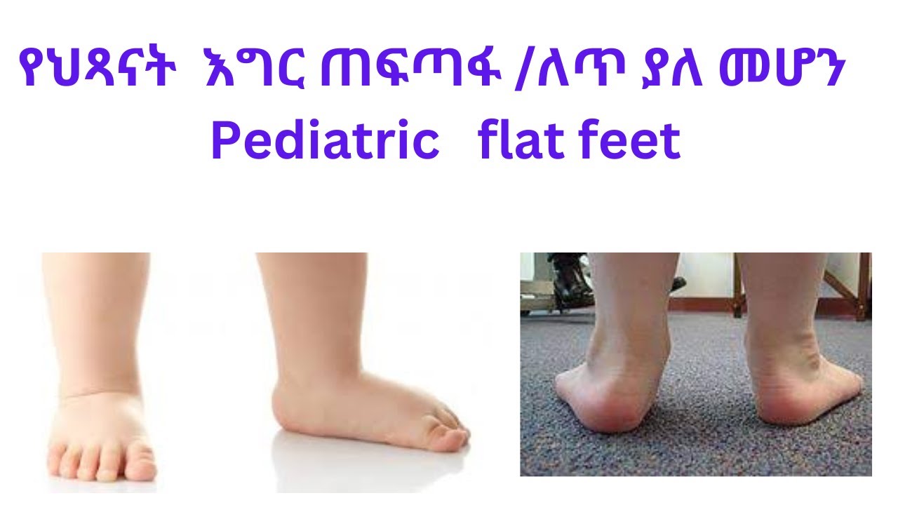 የህጻናት  እግር ጠፍጣፋ /ለጥ ያለ መሆን/ምንነት:ሃኪም መቼ ማማከር አለብን?   Pediatric flat feet