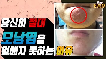 모낭염 100% 없앨 수 있다고!!!!!!!!! │모낭염 예방 방법?