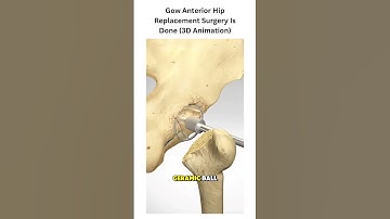 Gow Anterior Hip Replacement Surgery #medical3d #3danimation