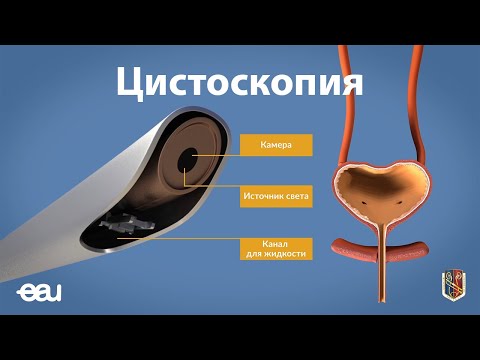Video: Цистоскопия эндоскопиябы?