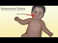 "Recognition of Respiratory Failure and Shock in Children" by Monica Kleinman