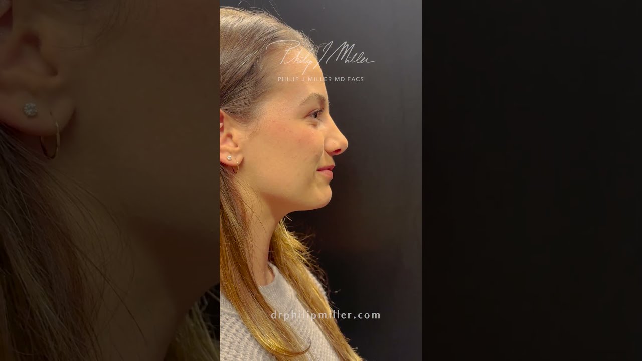 9 Months Post-Op Rhinoplasty!