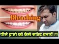 How To Whiten Your Yellow Teeth??| Dental Fluorosis Treatment |  Whitening Tooth by Bleaching Paste